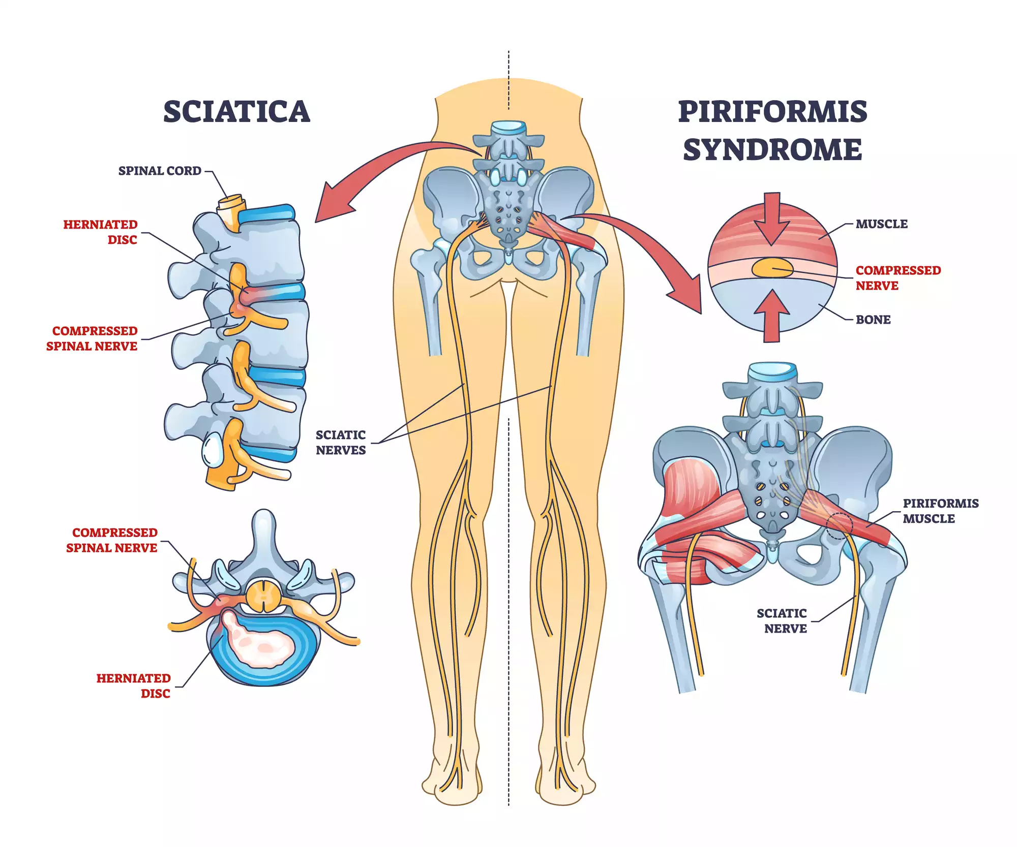 Read more about the article SCIATICA