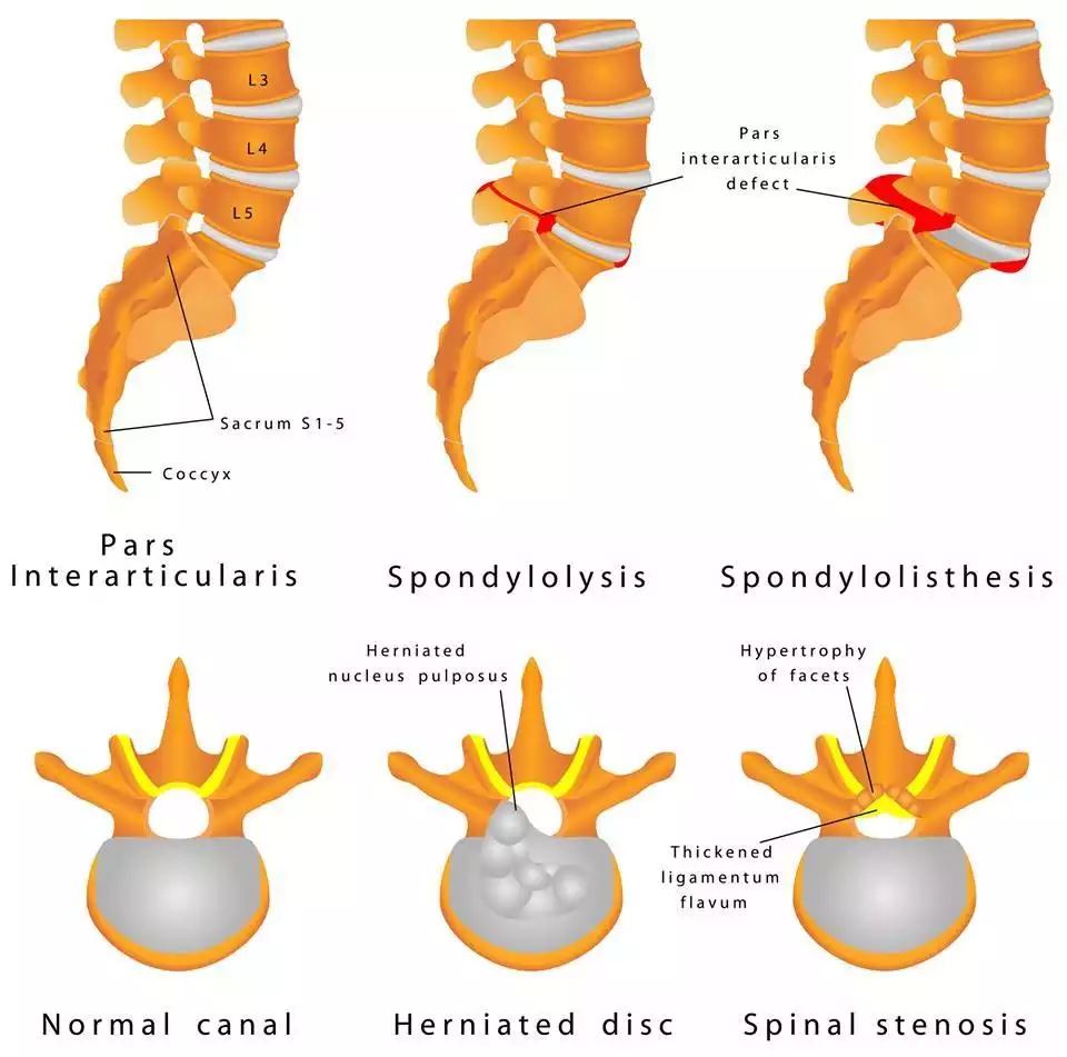 Read more about the article DIAGNOSIS: SUSPECTED ANKYLOSING SPONDYLITIS