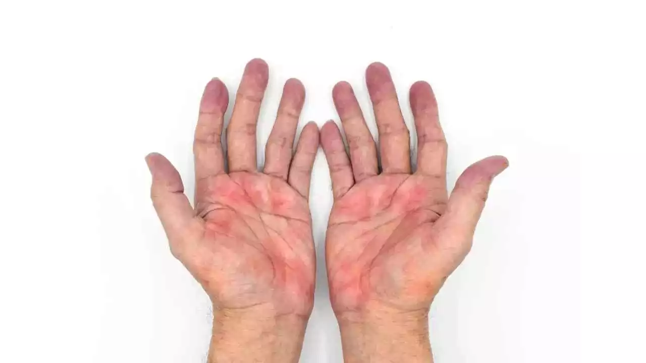 Read more about the article Q&A – Rashes on palms (English subtitles)