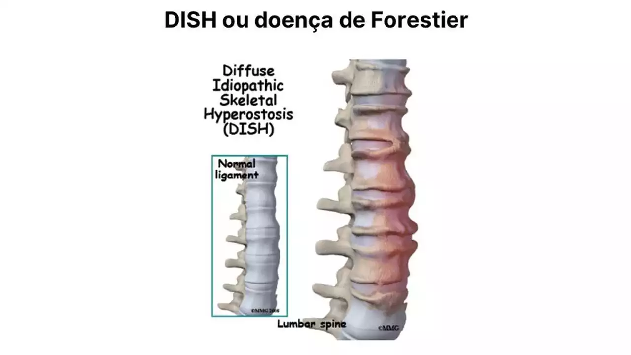 Read more about the article Q&A – Calcified growth in the lumbar region (English subs)