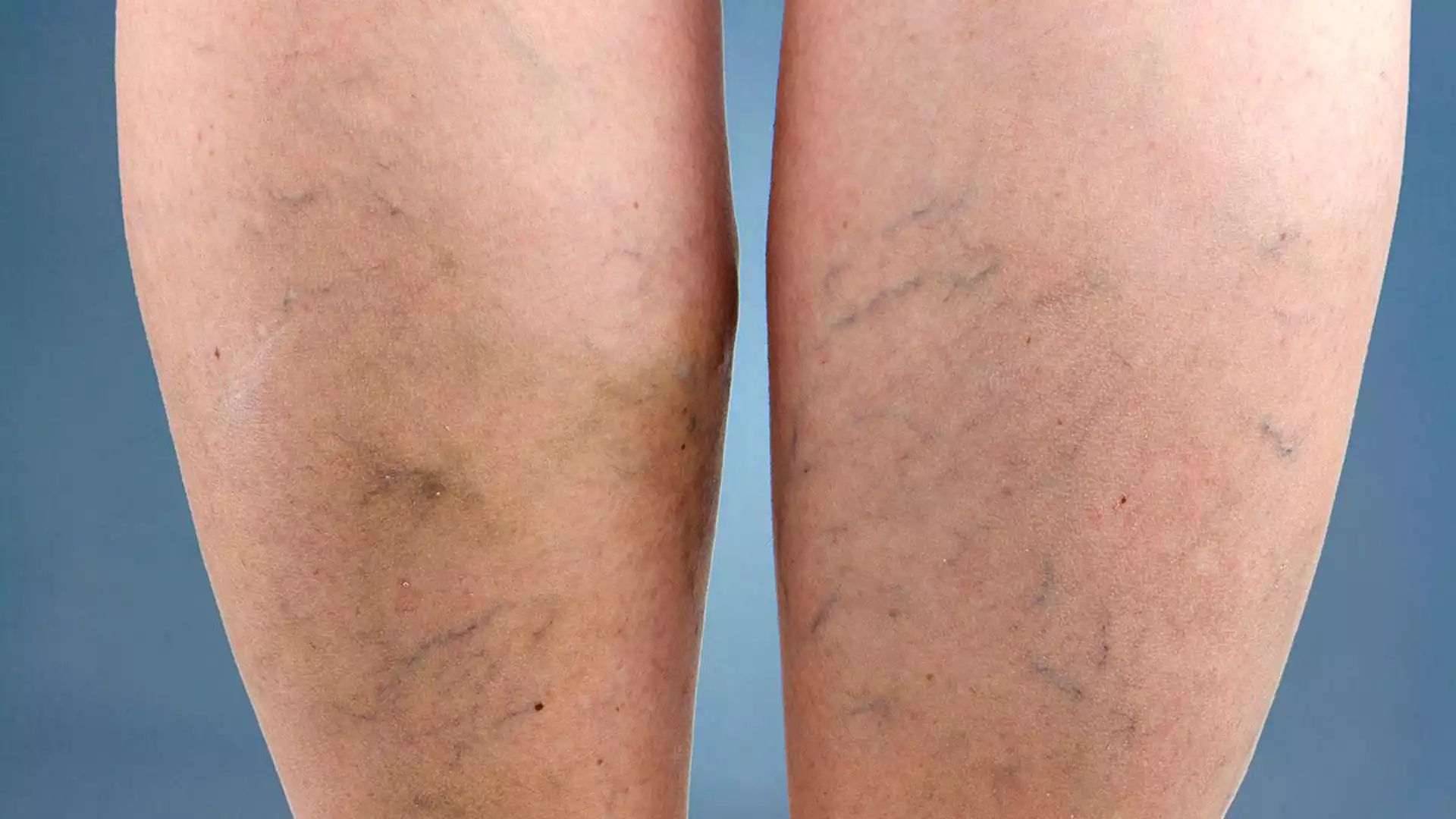 Read more about the article Q&A – How does the AEQ method view varicose veins (English subs)