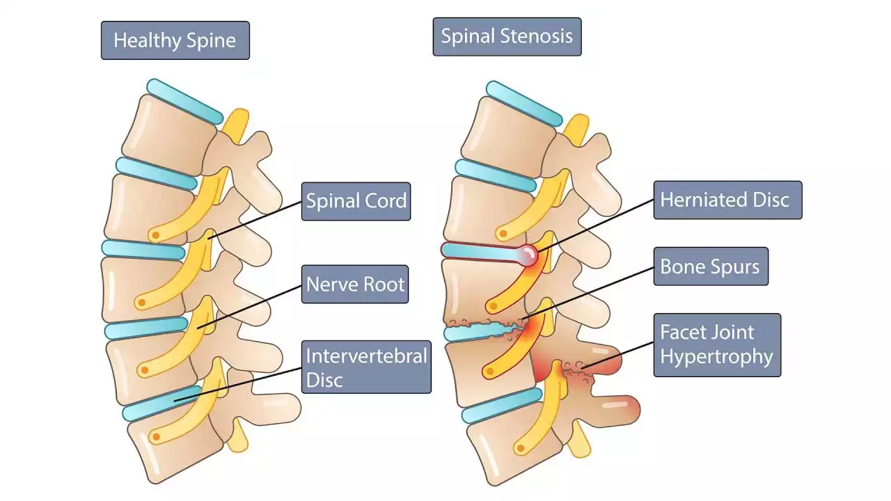 Read more about the article Q&A – Spinal stenosis (English subtitles)