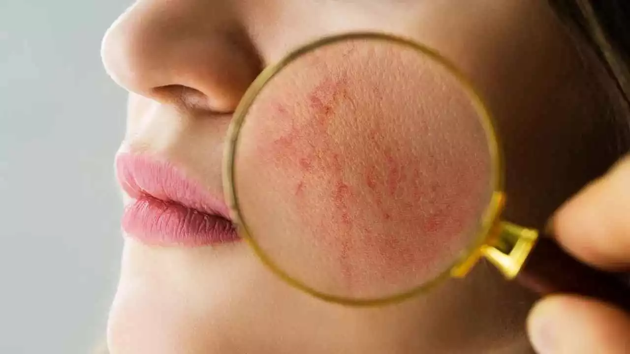 Read more about the article Q&A – Chronic rosacea (English subs)