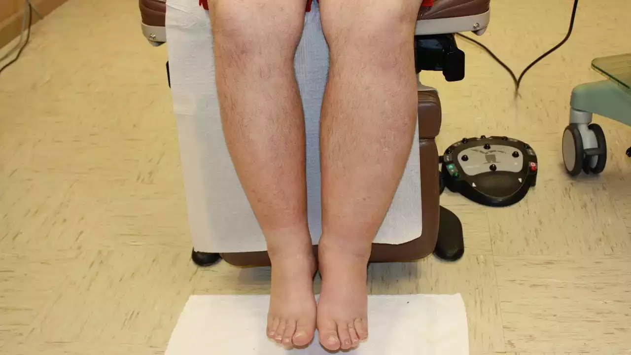 Read more about the article Q&A – Lymphedema of the left leg (English subs)
