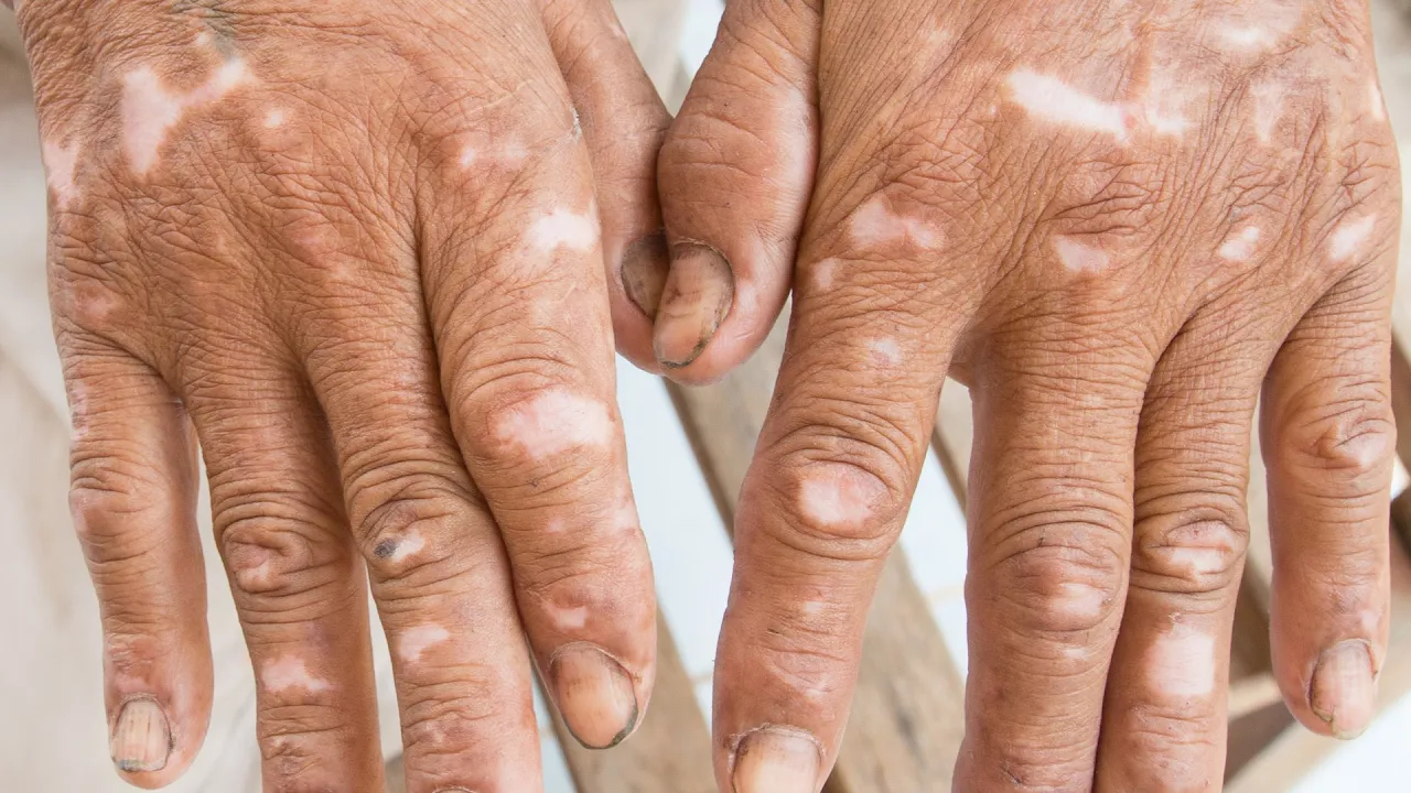 Read more about the article Q&A – Scleroderma, it’s causes, purpose and how to minimize the process (English subs)