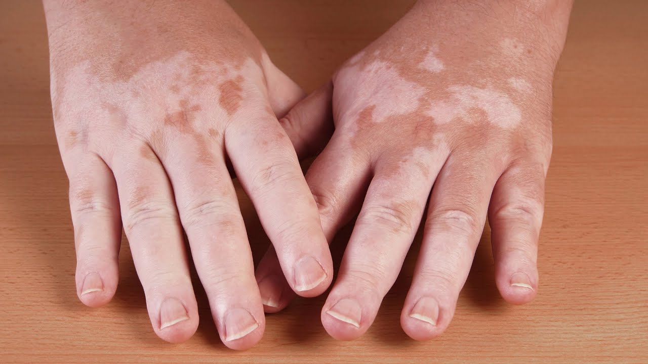 Read more about the article Q&A – Vitiligo (English subs)
