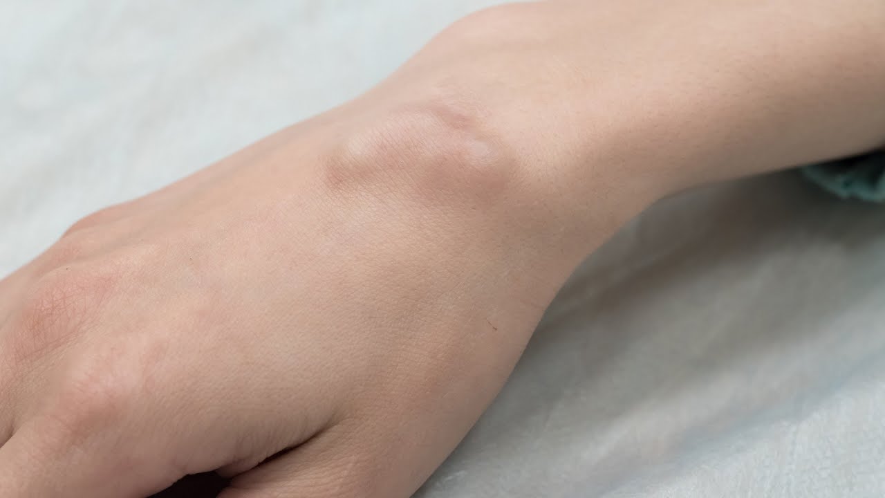 Read more about the article Q&A – Ganglion, causes and solutions (English subs)
