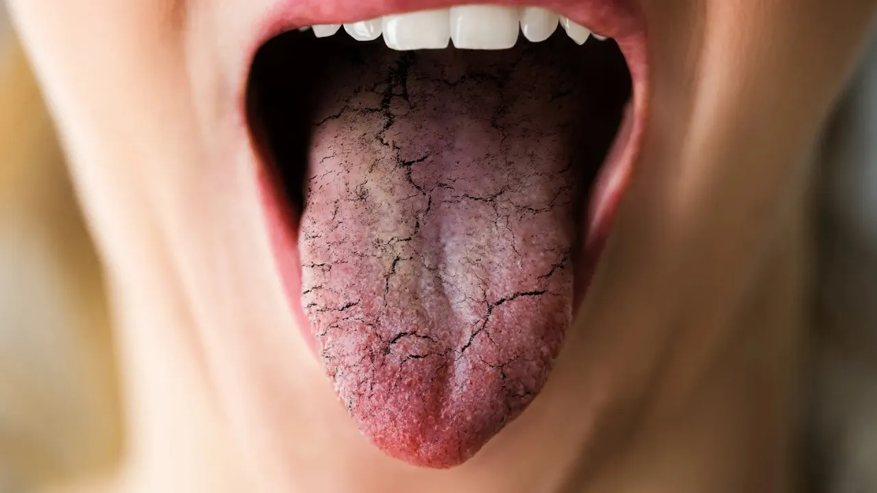 Read more about the article Q&A – Burning mouth syndrome (English subs)