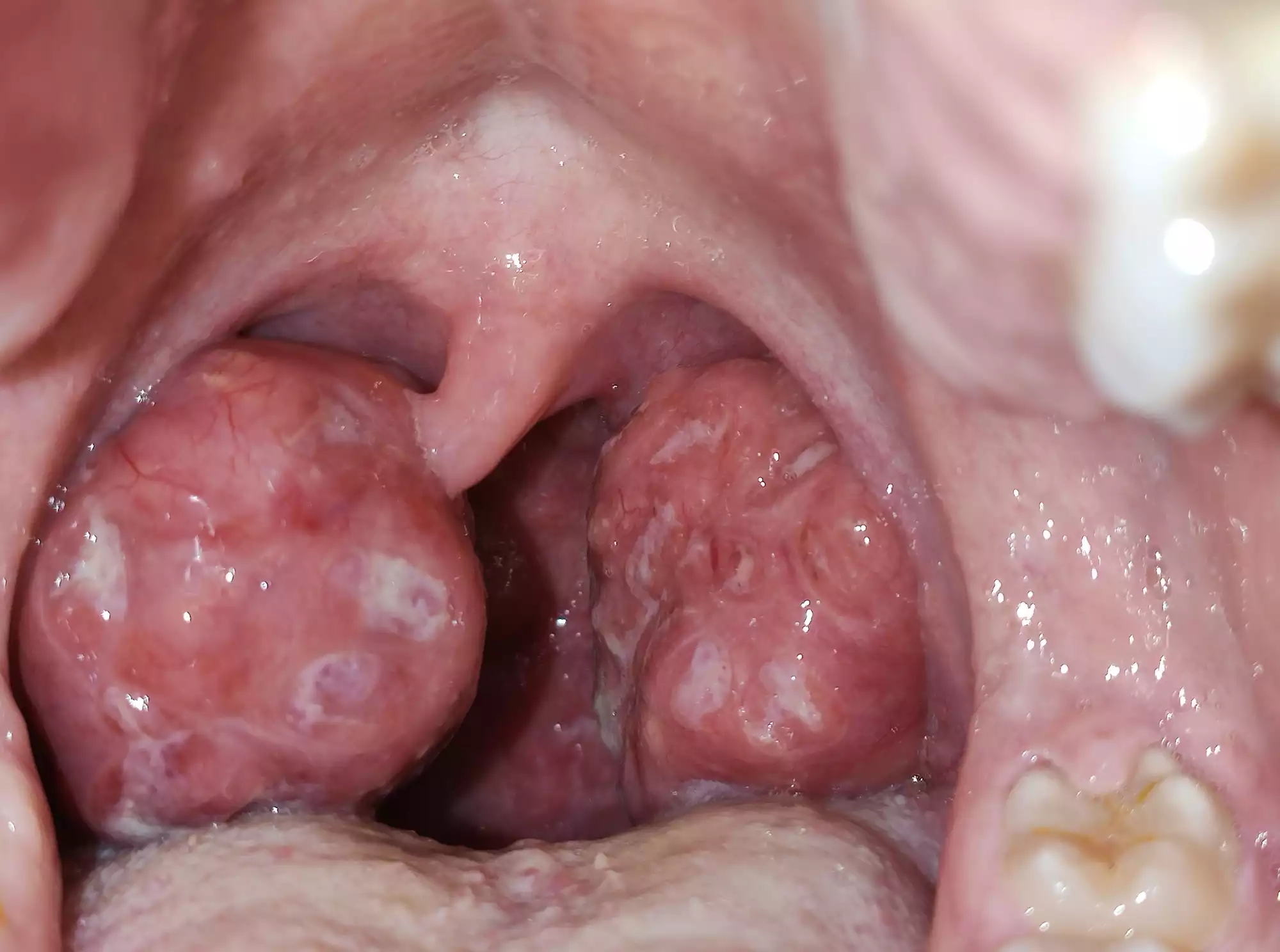 Read more about the article Tonsils as a Mirror of Family Dynamics